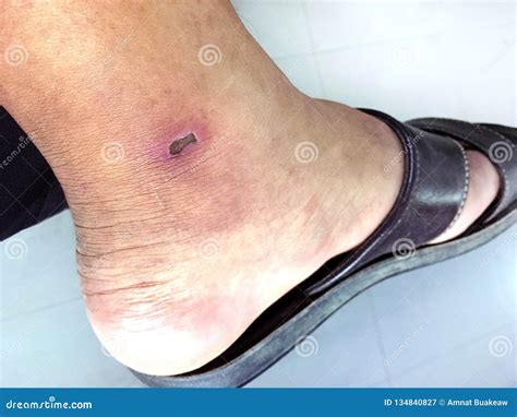 Lesion Scab Dried on the Epidermis Skin Ankle, Lesion, Dermatitis, Dark Spots of the Skin Legs ...