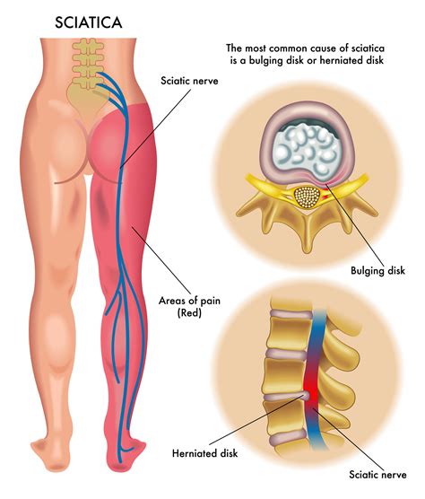 Sciatica: causes and treatment - ENG Eme Physio