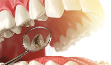 Dental Crown VS A Filling | Dr. Suffoletta, Functional Aesthetic Dentistry