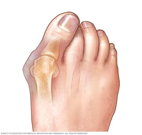 Why Does My Bunion Hurt When It's Cold at Linda Murray blog