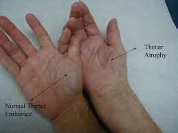 thenar - Google Search | Medical Board | Wrist anatomy, Physical ...