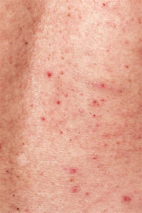 Scabies Rash What Does Scabies Look Like On Your Skin Mascarillas | Images and Photos finder
