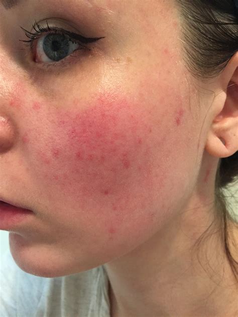 Rosacea Skin Rash On Face