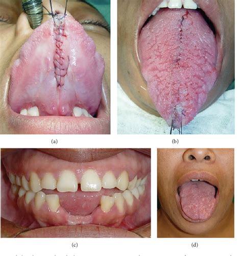 Figure 4 from Surgical Treatment of Congenital True Macroglossia | Semantic Scholar