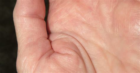 Free stock photo of Basal Joint Arthritis, Thumb Arthritis