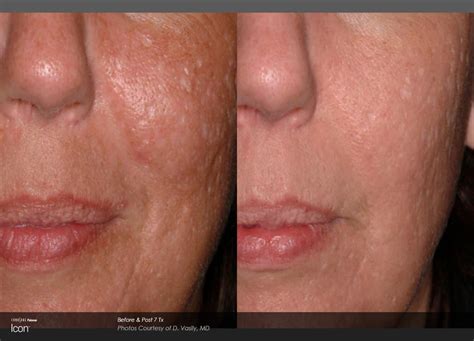 1540 Laser Skin Rejuvenation | Newport Medical and Wellness Center