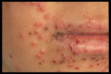 Eczema Herpeticum- A Rare Problem of Atopic Dermatitis. When eczema herpeticum is diagnosed ...