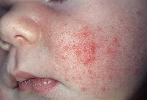 What Causes Rash On Child S Face - Printable Templates Protal