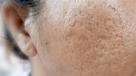 All Types of Acne Scars — and How to Get Rid of Them All - Greatist pro