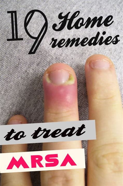 www.homeremedyhacks.com/19-home-remedies-to-treat-mrsa/ | Remedies, Home remedies for warts ...