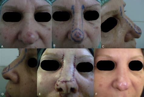 Application of modified Rintala flap in nasal tip reconstruction | Ento Key