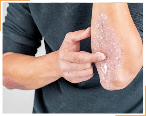 Psoriasis vs Eczema | Natural Psoriasis TreatmentNatural Psoriasis Treatment