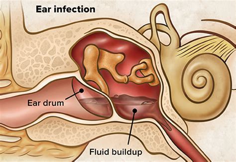 Ear Tubes | Patient and Family Education | UC Davis Children Hospital