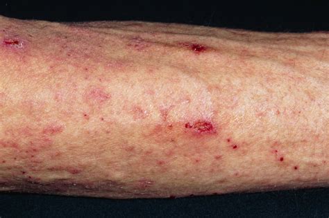 Diabetic Skin Rash On Arms And Wrists - DiabetesWalls