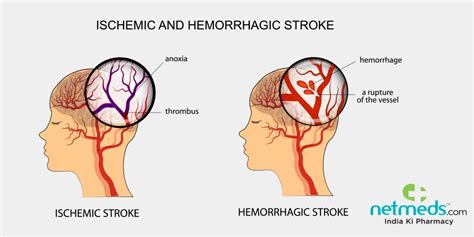 Stroke/Cerebrovascular Accident Causes, Symptoms And Treatment