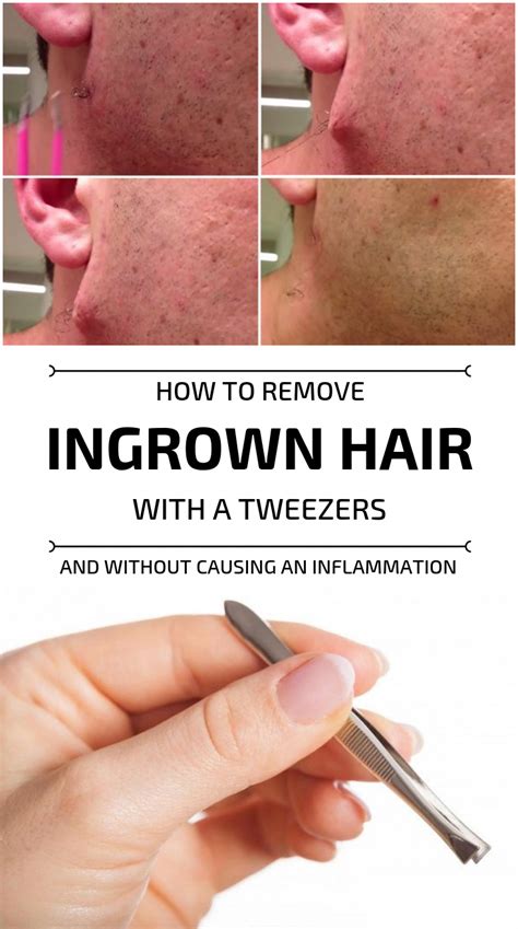 How To Remove Ingrown Hair Neck - HOWTOERMOV