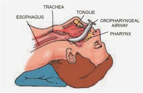 Oropharyngeal Airway (OPA) ~ Nursing