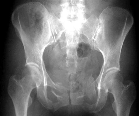 Pelvic Fracture X Ray