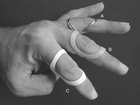 Splinting for the Fingers | Musculoskeletal Key