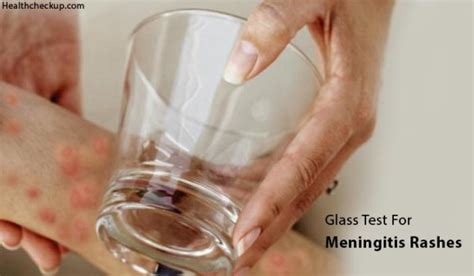 Glass Test For Meningitis Rash | Signs, Symptoms of Meningitis in ...