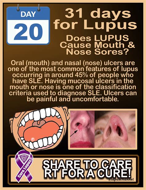 Pin on #LUPUSAwarenessMonth #31DaysOfLupus Infogifs to share!