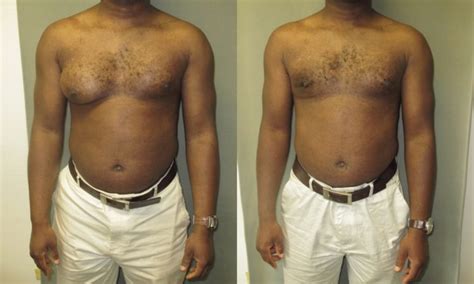 Gynecomastia — Symptoms and Treatment | Online Medical Library