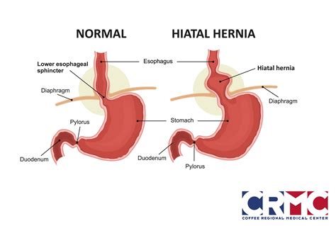 Could a Hiatal Hernia Be Causing Your Reflux? | Coffee Regional Medical Center