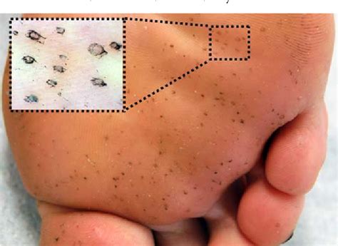 [PDF] Dermoscopy of Pitted Keratolysis | Semantic Scholar
