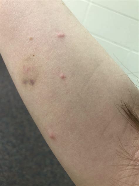 What Do Bed Bug Bites Look Like On A Person at Virginia Sorrells blog