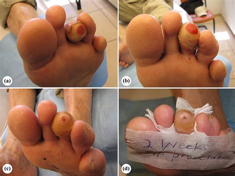 Table 1 from Percutaneous Tenotomy for the Treatment of Diabetic Toe ...