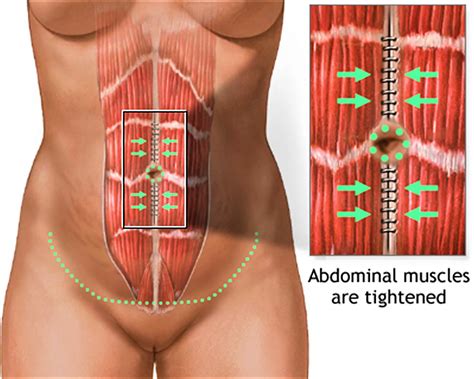 Abdominoplasty Surgery - Recovery, Before and After, Risks