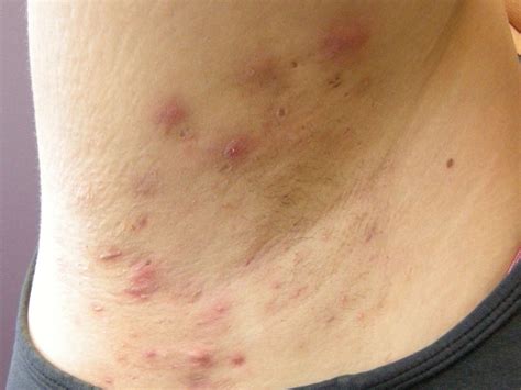 Could Your Painful Pimples Be Hidradenitis Suppurativa? (2023)