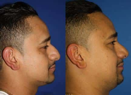 Hispanic Rhinoplasty New York City, New York | Dr. Philip Miller