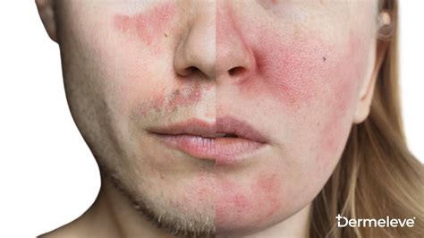 Understanding Lupus Rashes: Butterfly Rash vs Rosacea – Dermeleve®