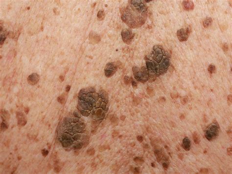 Seborrheic Keratosis Condition Treatments And Pictures For Adults | Sexiz Pix