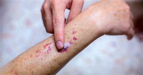 Purpuric Rash Causes, Pictures, and When to Get Medical Help