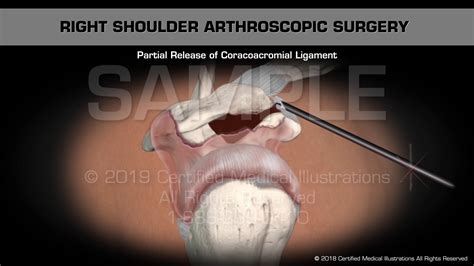 Arthroscopic Surgery of Right Shoulder - Medical Animation - YouTube