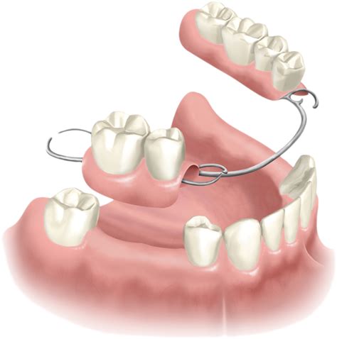 Partial Dentures Windsor CT | Removable Dentures