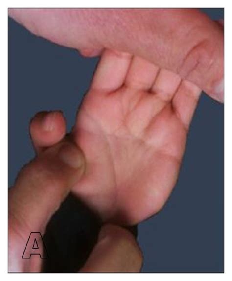 Palmar features. (a) The left palmar creases bridged to form one and... | Download Scientific ...