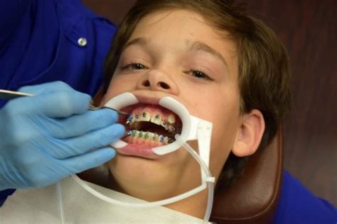 What to Expect at Your First Orthodontist Appointment - A Mom's Take