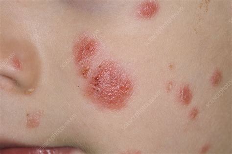 Psoriasis Skin Rash On Face