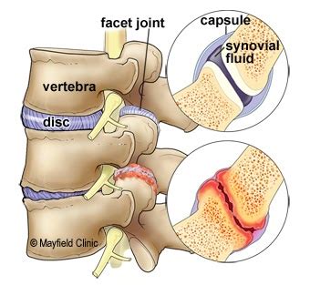 Facet Joint Syndrome and Pain - Peak Form Health Center