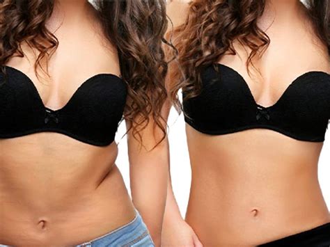 Reverse Tummy Tuck Before and After - Cosmetic Surgery Tips