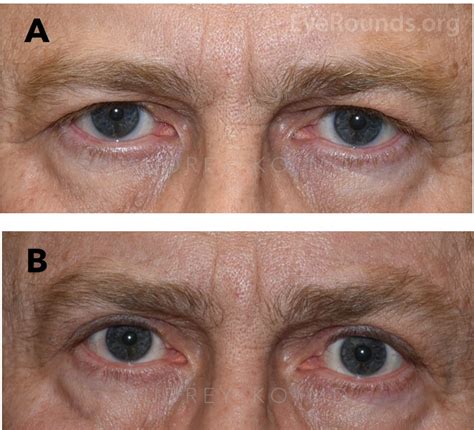 Brow Ptosis Correction: Direct Browplasty and Progression of Facial Scars