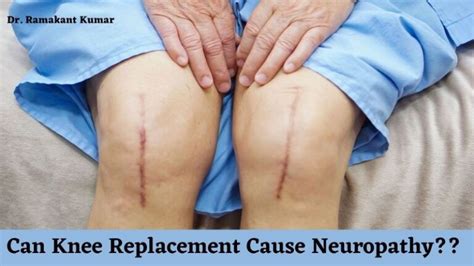 Numbness Foot after Knee Surgery Archives - Enliven Articles