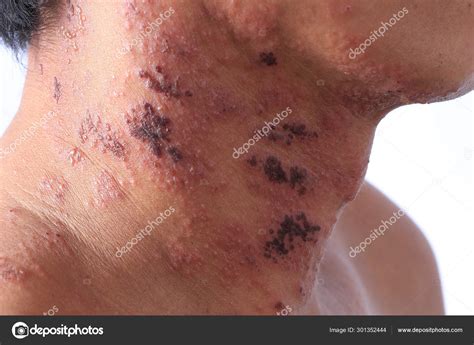 Hsv Vs Vzv Rash : 25 Herpes Simplex And Zoster - The symptoms of specific rashes are typically ...