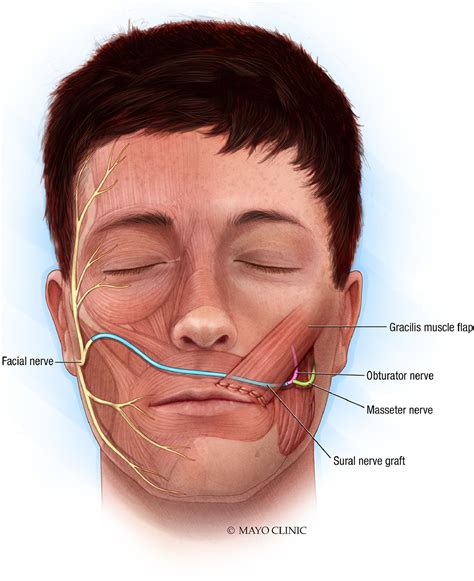 Dual innervation of free gracilis muscle for facial reanimation: What ...