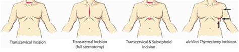 Thymoma