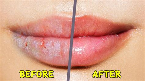 How To Fix Chapped Peeling Lips