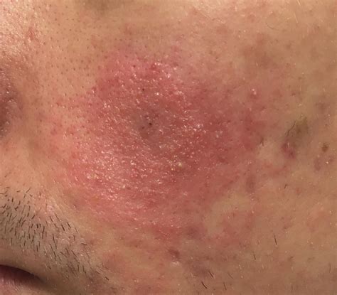 [Acne] Benzoyl-peroxide side effects or allergy? : r/SkincareAddiction